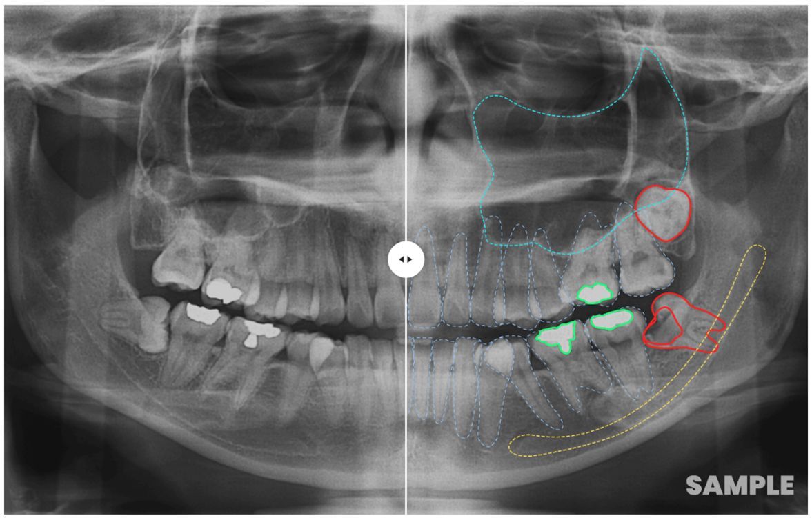 AI Detection X- Ray Image