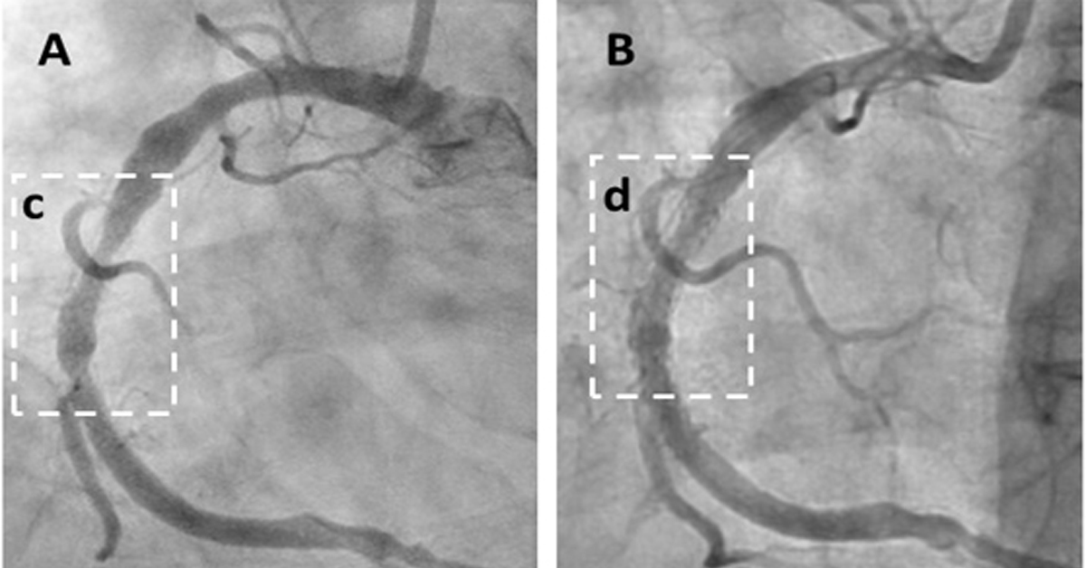 Angiogram: Plaque Reduced Within 6 Weeks